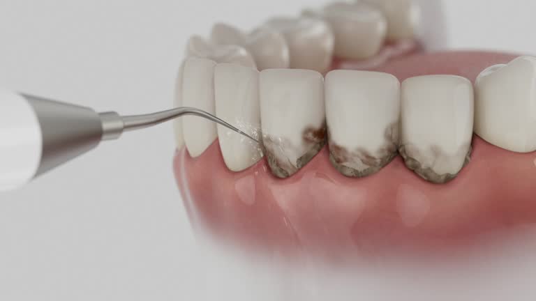 Trusted Wisdom Tooth Removal service in Oakland Park, FL - Dentist Open Now